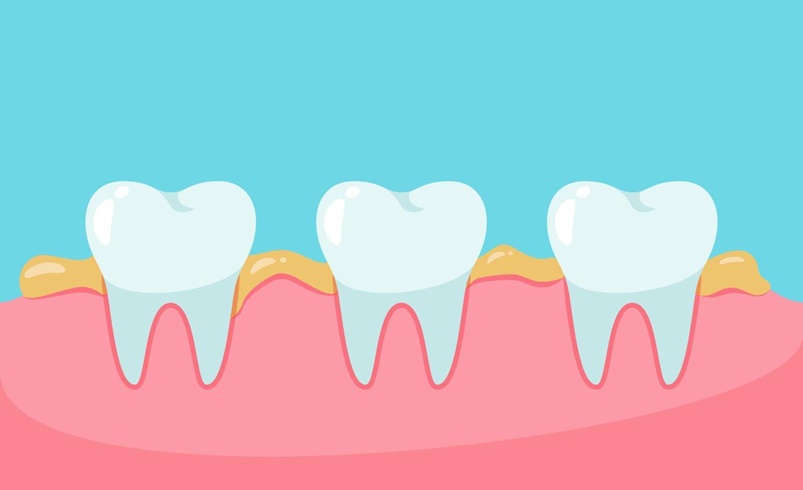 سلامت و روان-جرم دندان