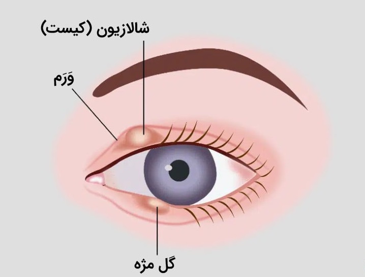 سلامت و درمان-چشم-گل مژه